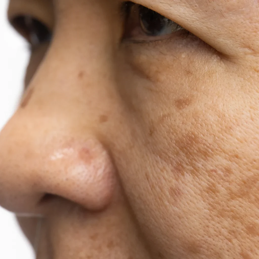 Retinoid Rash The Ultimate Guide to Retinoids for Glowing Skin